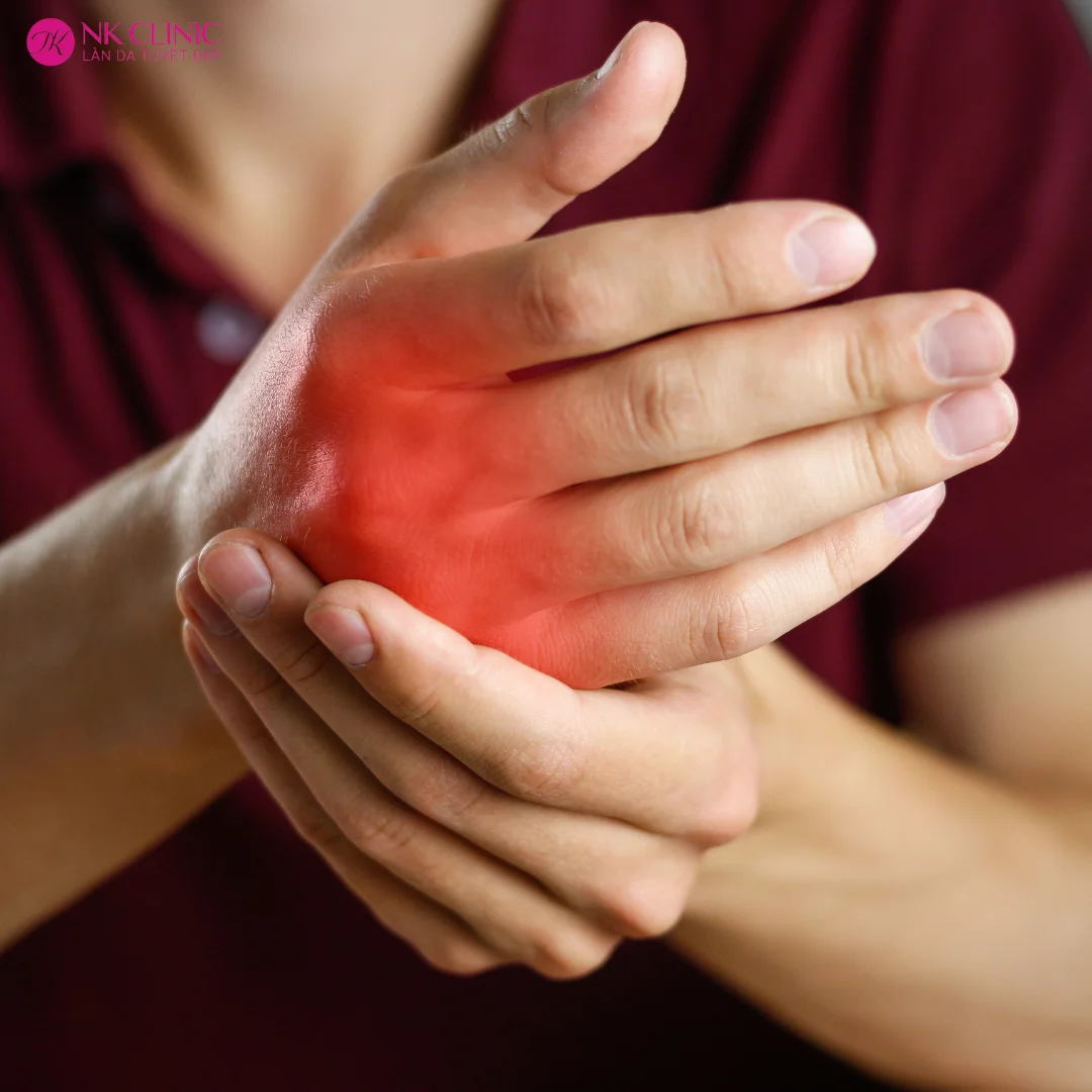 Viêm khớp dạng thấp Viêm khớp dạng thấp