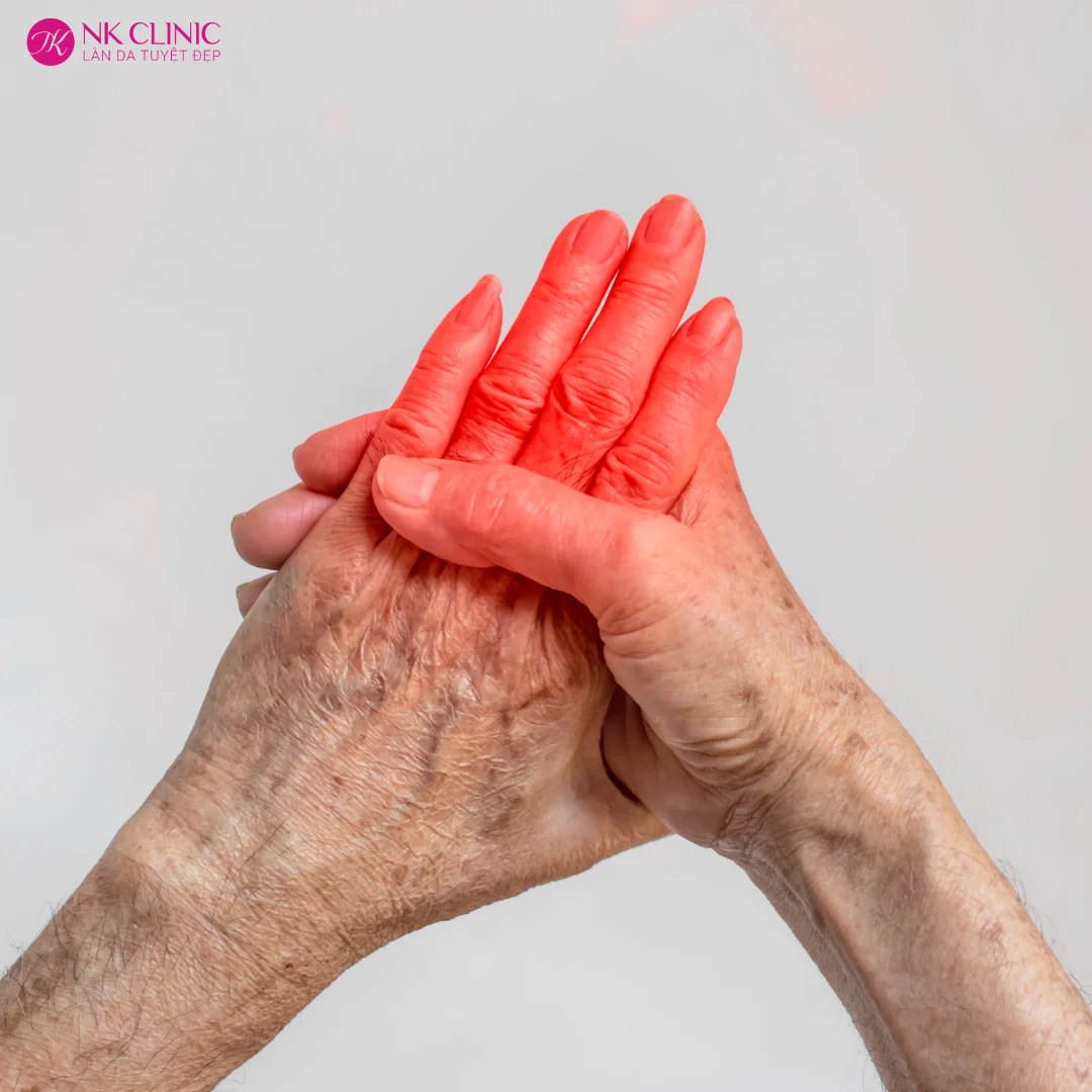Viêm khớp dạng thấp Viêm khớp dạng thấp