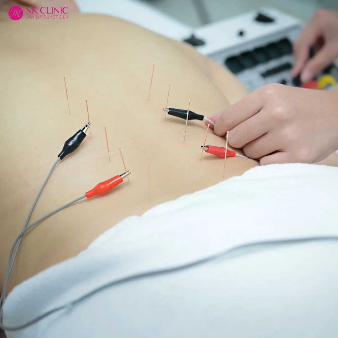 Châm cứu điện sử dụng dòng điện rất nhỏ truyền qua các kim châm Châm cứu điện sử dụng dòng điện rất nhỏ truyền qua các kim châm