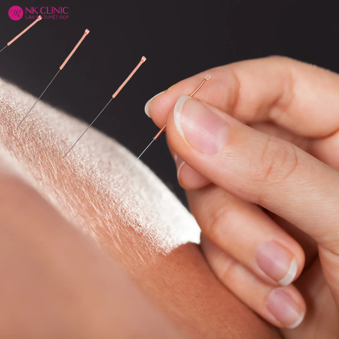 Châm cứu đôi khi là cảm giác tê hoặc ấm lên tại vùng huyệt Châm cứu đôi khi là cảm giác tê hoặc ấm lên tại vùng huyệt