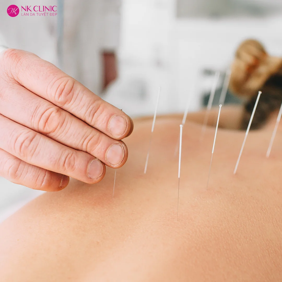 Châm cứu kích thích các huyệt đạo trên cơ thể Châm cứu kích thích các huyệt đạo trên cơ thể