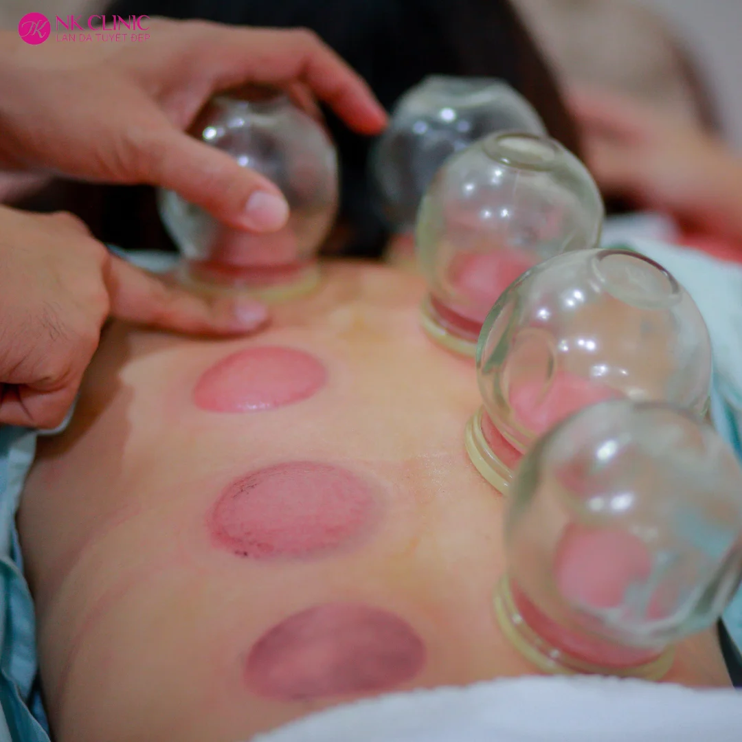 Vết bầm tím sau giác hơi là phản ứng bình thường của cơ thể Vết bầm tím sau giác hơi là phản ứng bình thường của cơ thể