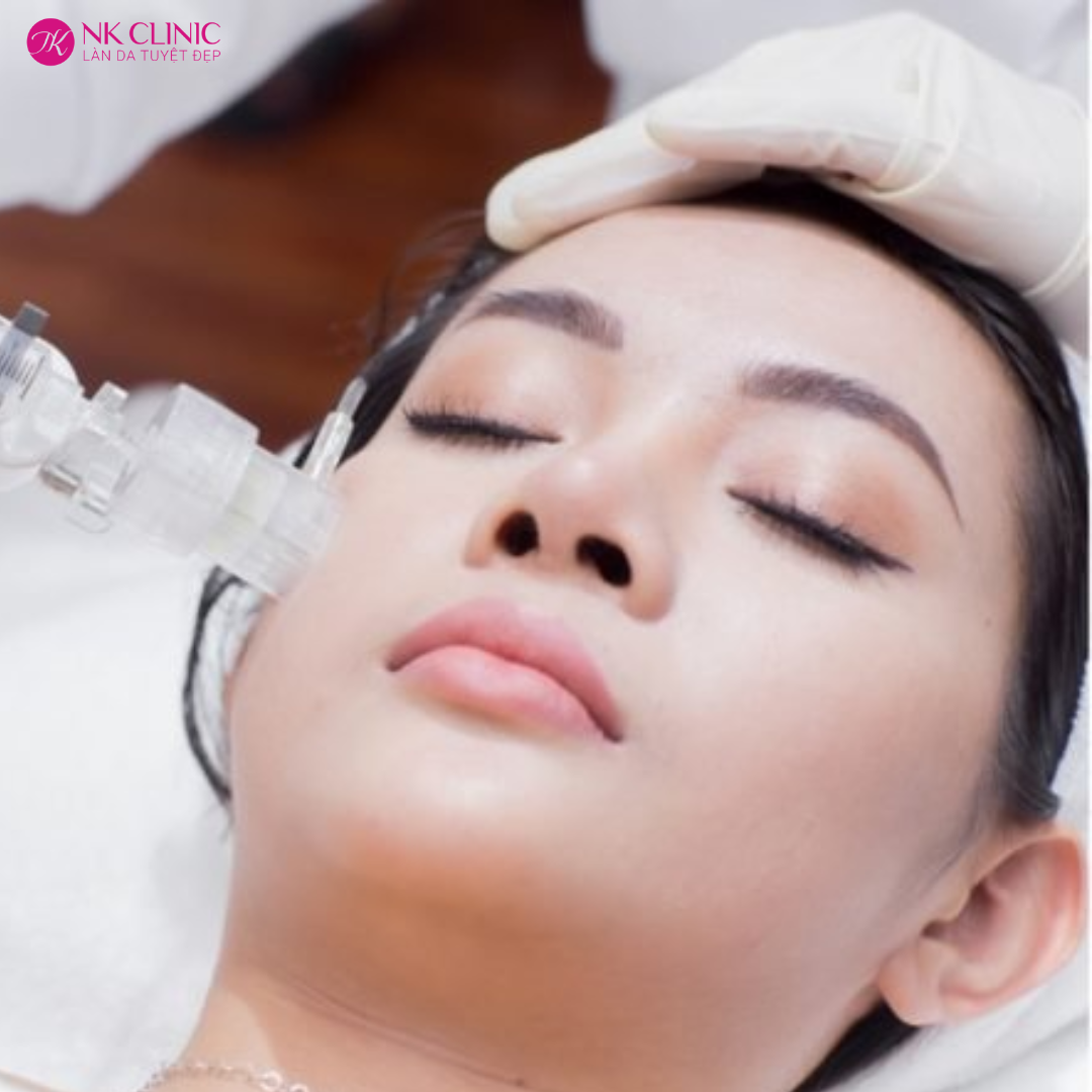 Cấy căng bóng da mặt có tốt không? Cấy căng bóng da mặt có tốt không?