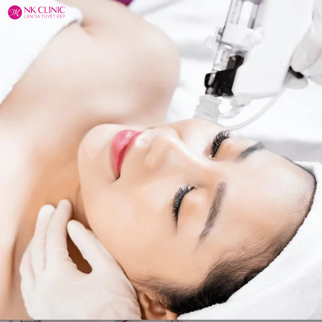 Cấy căng bóng da mặt Cấy căng bóng da mặt