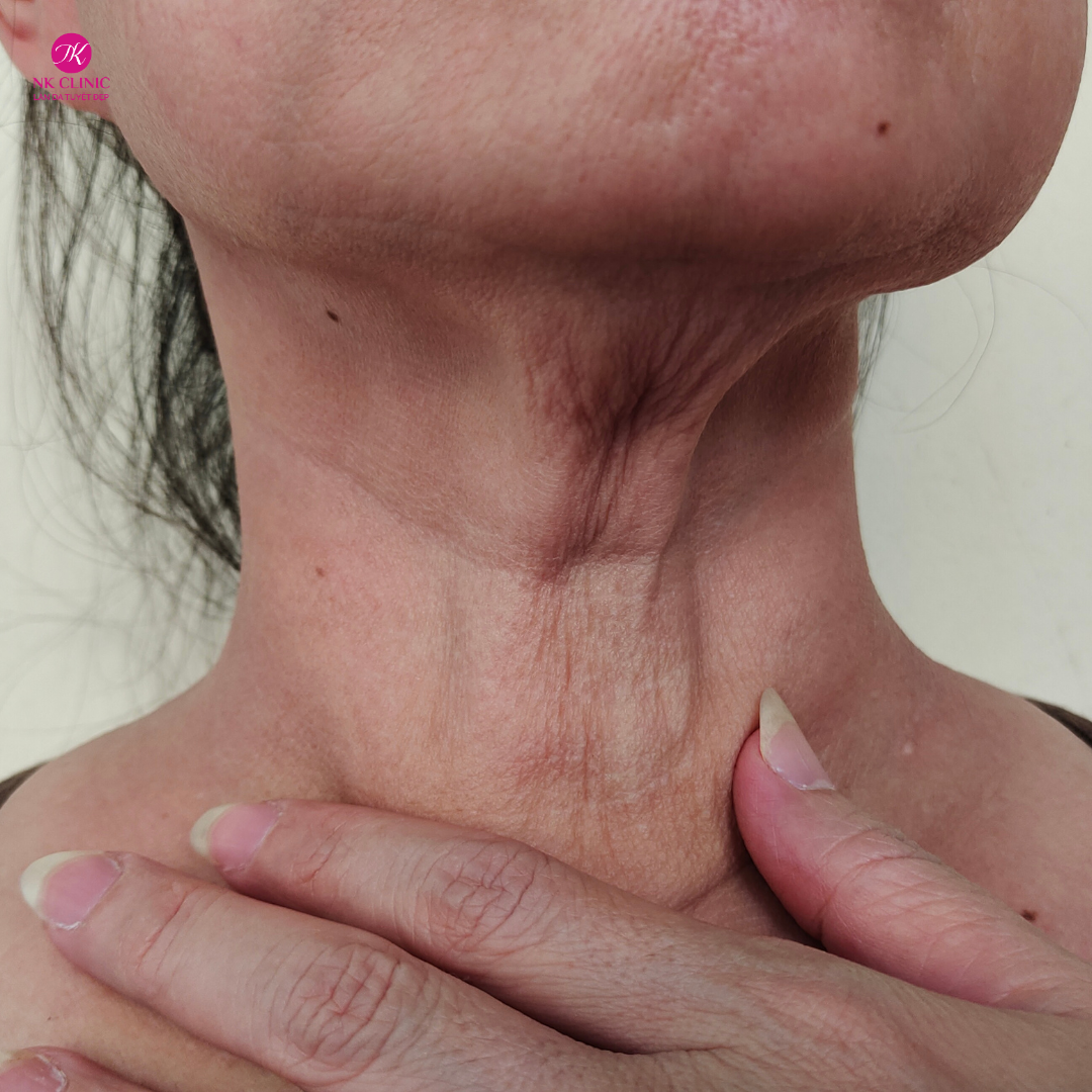 Nguyên nhân vùng da cổ gặp hiện tượng chảy xệ Nguyên nhân vùng da cổ gặp hiện tượng chảy xệ