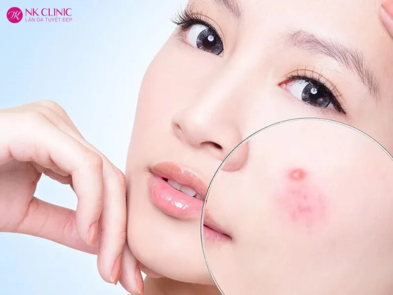 Những điều bất di bất dịch cần biết trước khi massage da mụn