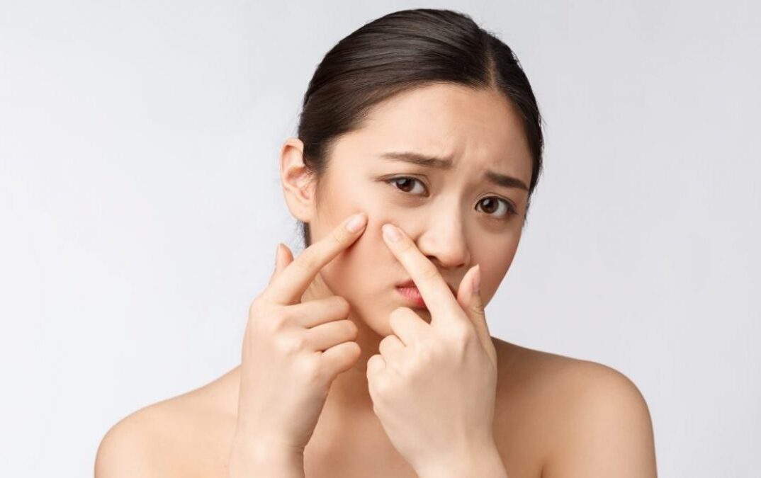 Hướng Dẫn 7 Cách Massage Mặt Trị Mụn An Toàn Mà Bạn Cần Biết 9 cách massage mặt trị mụn